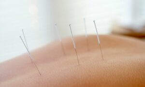 pain relief through acupuncture and chiropractic Huang Wellness Center